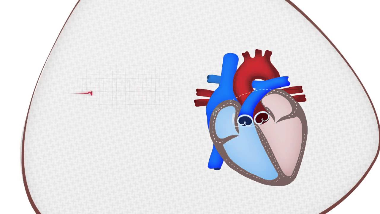 Comment expliquer un arret cardiaque
