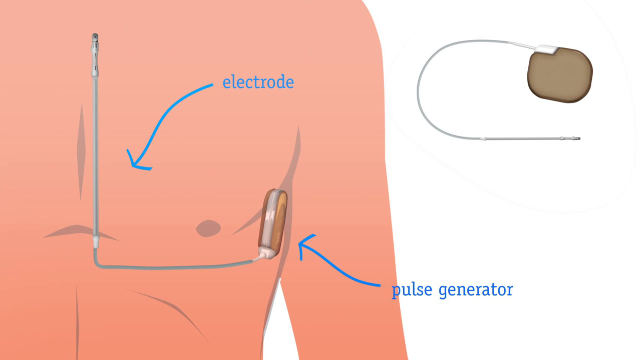 Subkutane ICD (S-ICD) implantatie