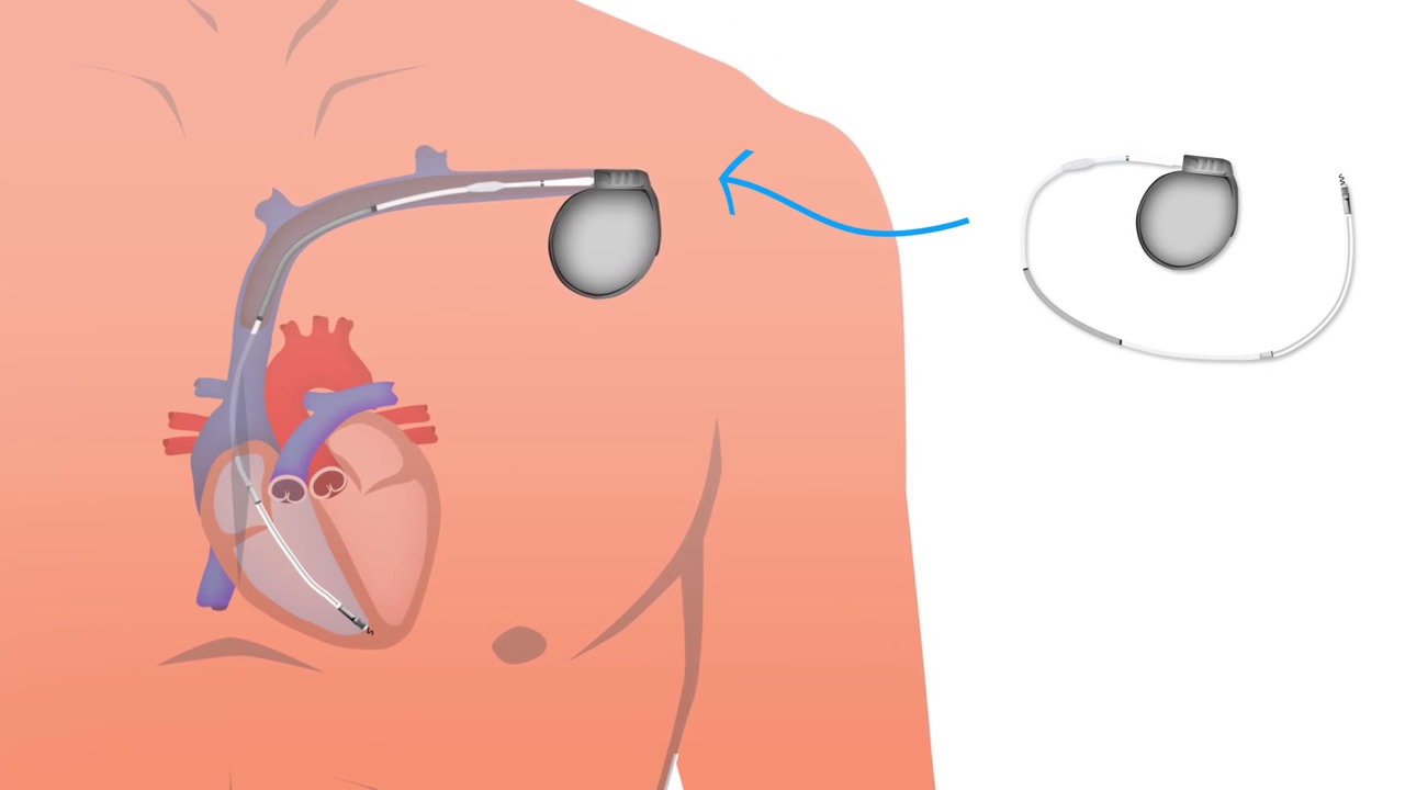 Watch video on a transveneous ICD implant procedure Watch video on a transveneous ICD implant procedure