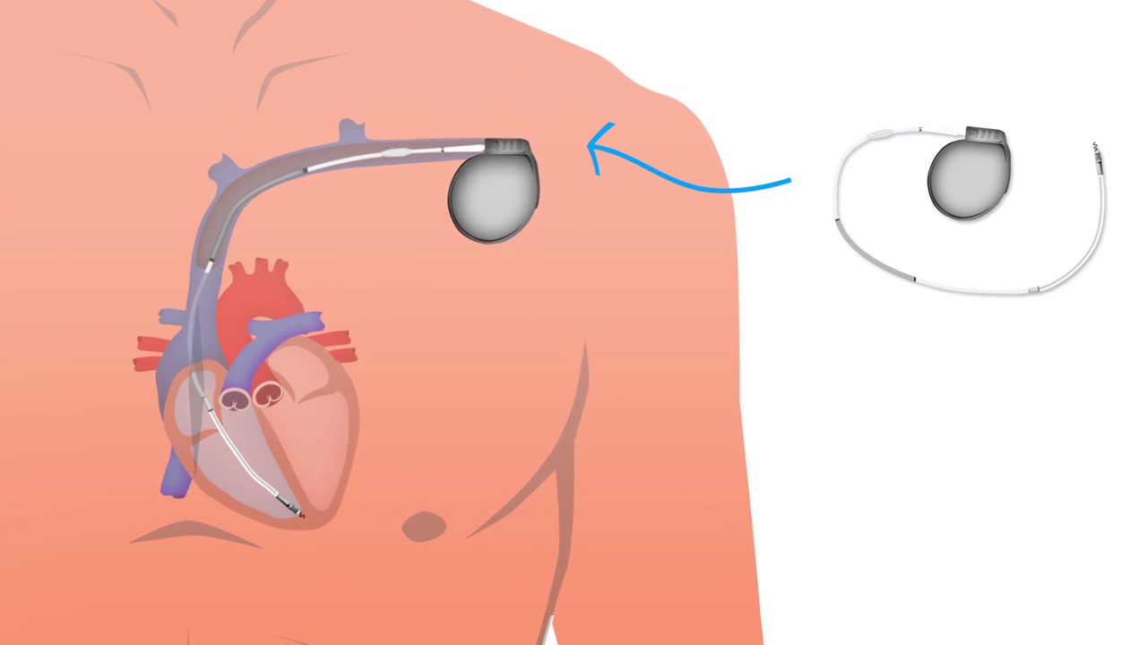 Transveneuze ICD (TV-ICD) implantatie