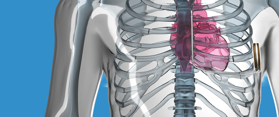 S-ICD en comparación con otros dispositivos: