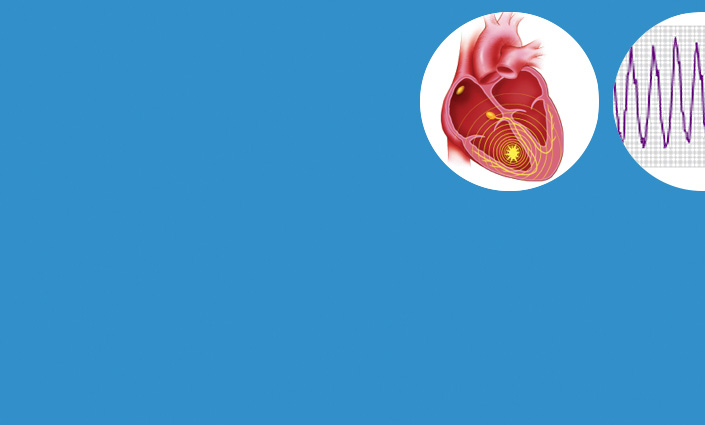An S-ICD Works Even If You Feel No Symptoms An S-ICD Works Even If You Feel No Symptoms