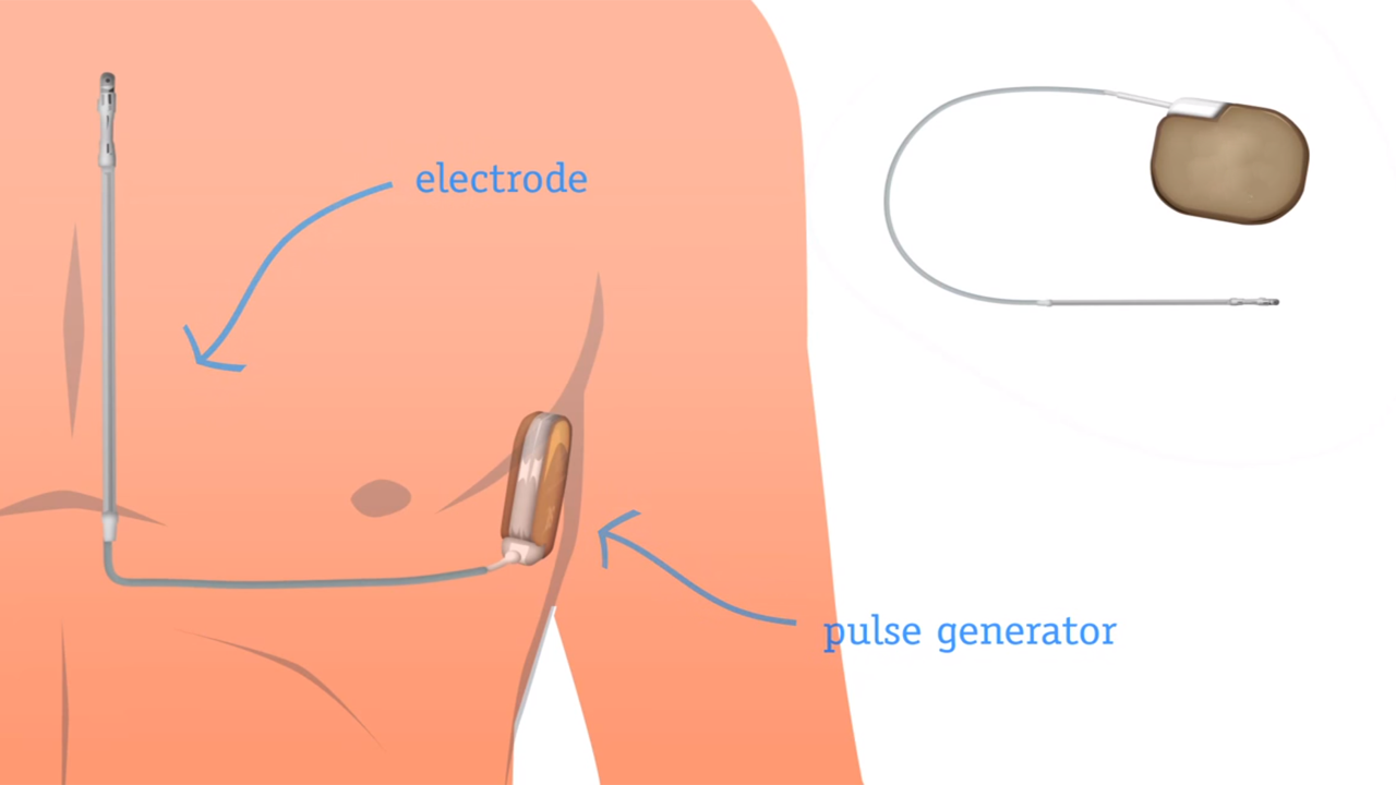 Watch video on the S-ICD. Watch video on the S-ICD.