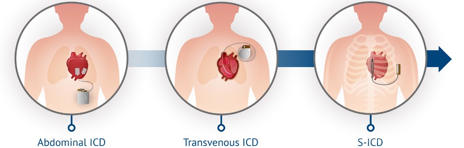Illustration of the S-ICD vs Traditional ICDs