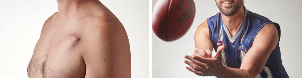 Male transvenous ICD patient device scar and Male transvenous ICD-patient playing Australian football