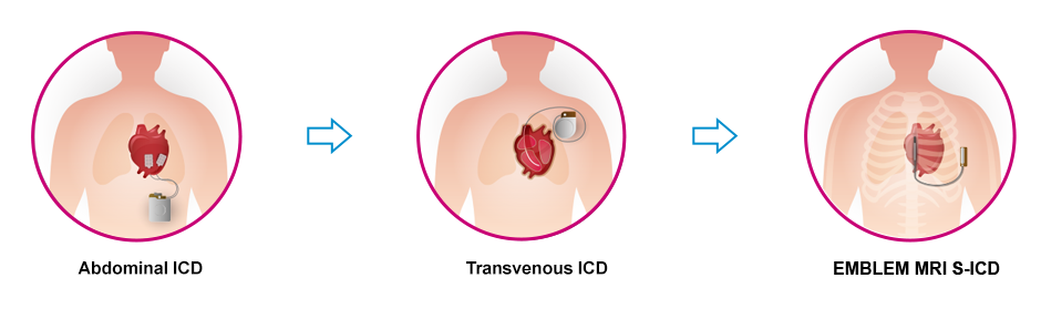 ICD Device Evolution to S-ICD