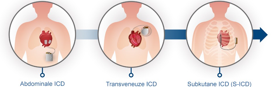 Evolutie van ICD-apparaten naar de S-IDC
